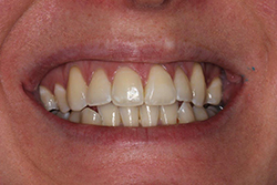 Straight Teeth with Dental Braces | Dental Excel Blog