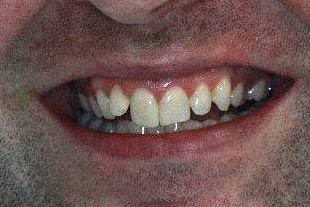 Inman Aligner Before
