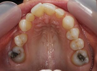 Orthodontics Before