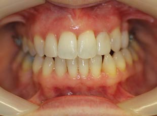 Orthodontics After