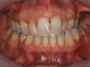 Orthodontics Before