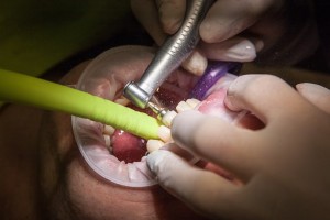 How Long do Tooth Fillings Last | Dental Excel Blog