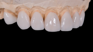 Porcelain Dental Veneers | Manufactured Precisely with a Mould