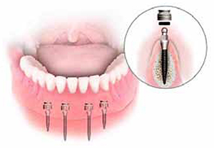 Dental Excel Mini Dental Implants Beerwah or Palmwoods